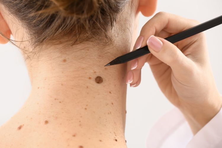 Understanding the Unique Expertise Behind Specialized Skin Cancer Care